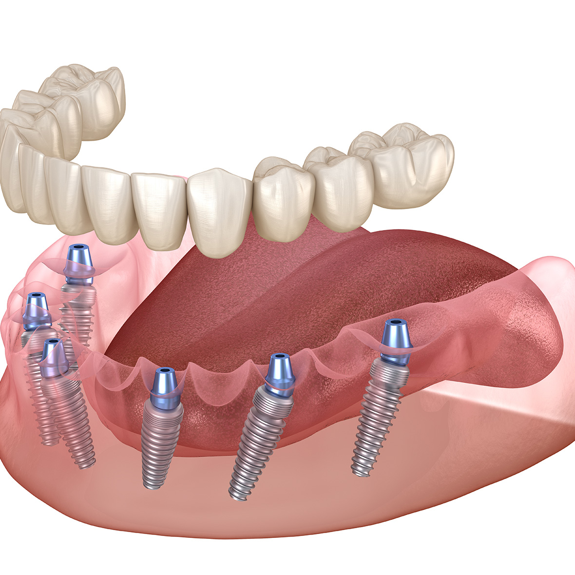 All-on-6: Zahnersatz auf 6 Implantaten.